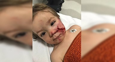 Ankara'da pitbull saldırısına uğrayan 1,5 ve 5 yaşındaki kardeşler yaralandı