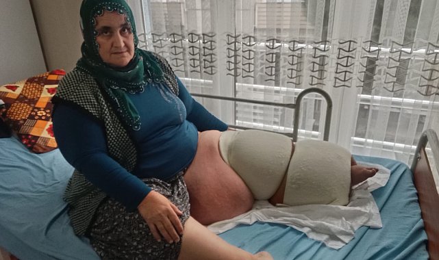 35 yıldır fil hastalığıyla mücadele ediyor