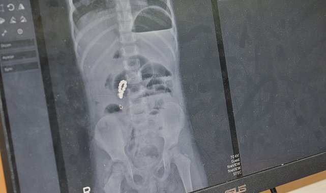 4 yaşındaki Eda'nın bağırsağından 8 adet mıknatıslı boncuk çıkarıldı