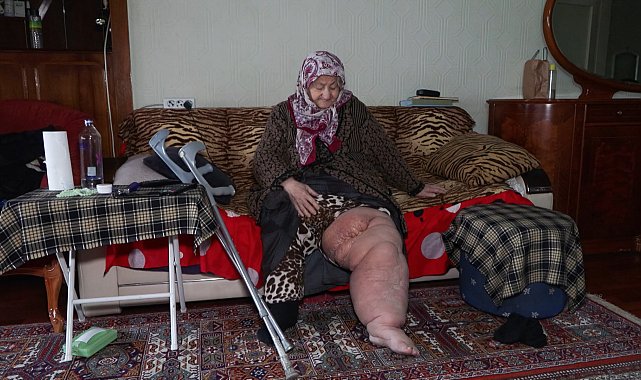 İstanbul - Fil hastalığıyla mücadele ederken oturduğu evin yıkılacağını öğrendi; 'Bacağım bu haldeyken nereye gideceğim'