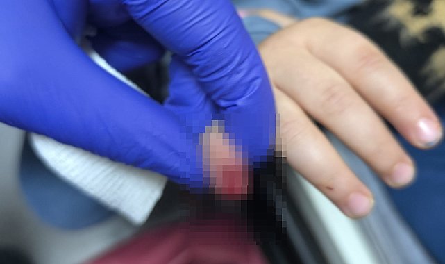AVM'de yürüyen merdivene eli sıkışan çocuğun parmağı koptu