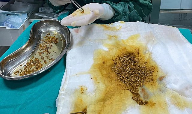 Karın ağrısı şikayetiyle gittiği hastanede safra kesesinden 2 bin 67 taş çıkarıldı