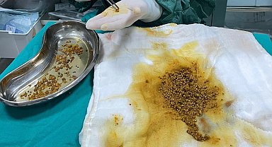 Karın ağrısı şikayetiyle gittiği hastanede safra kesesinden 2 bin 67 taş çıkarıldı