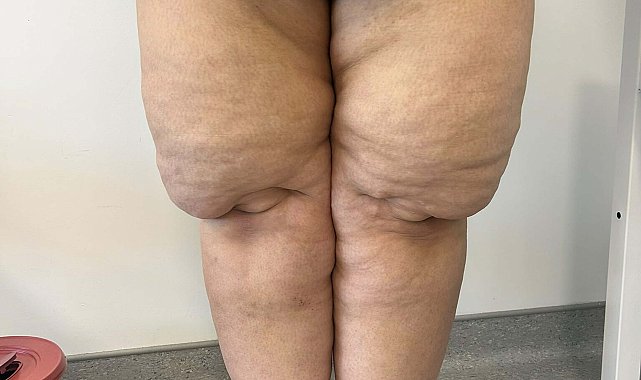Bacaklardaki simetrik ağrı ve morarma, lipodemin işareti olabilir