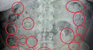 Midesinde yarım kilo uyuşturucu tespit edilen şüpheli tutuklandı