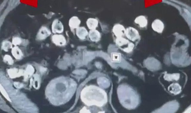 2 kilo 675 gram Afyon sakızı yuttuğu tespit edilen 3 şüpheli tutuklandı