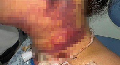 Estetik ameliyatı sonrası yoğun bakımda 2 gün tedavi gördü, doktor hakkında şikayetçi oldu