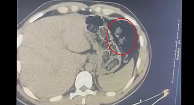Midelerinden uyuşturucu taşıyan 2 şüpheli tutuklandı