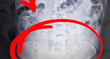 Midelerinden uyuşturucu çıkan 4 şüpheli, tutuklandı