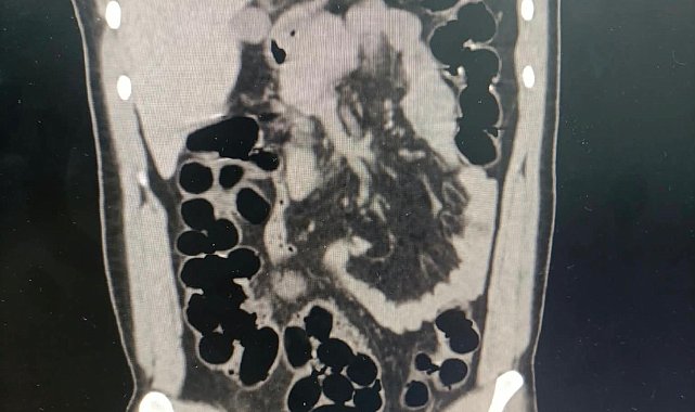 Midesinden kapsüller içinde 943 gram eroin çıktı
